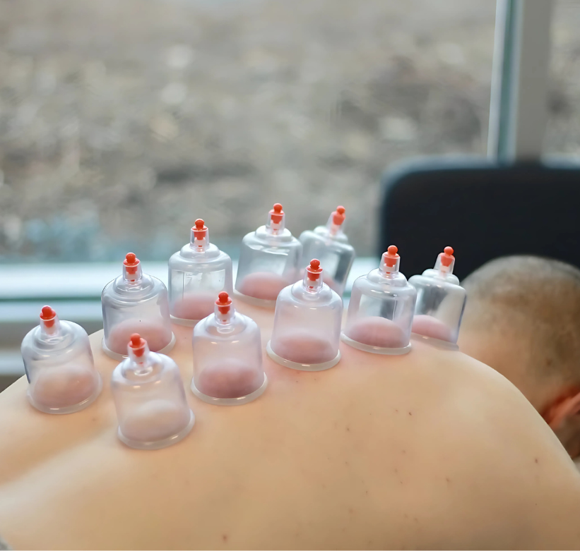 হিজামা (Cupping Therapy): সুন্নাহসম্মত চিকিৎসা ও সুস্থতার এক প্রাচীন পদ্ধতি